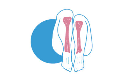 Disimetría de miembros inferiores unida a pies planos semirrígidos.