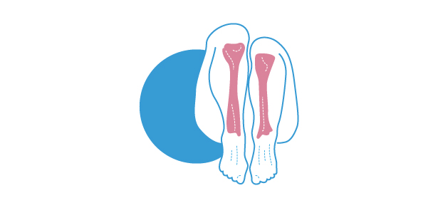 Qué es la disimetría de miembros inferiores unida a pies planos semirrígidos.