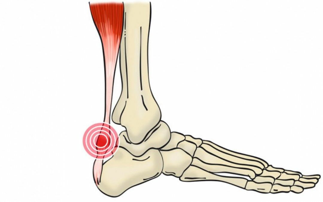 Qué es la tendinopatía aquílea.