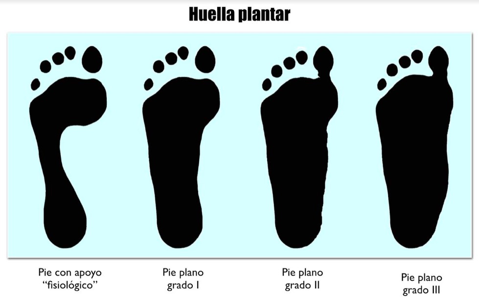 Tendinopatía del músculo tibial posterior en paciente con pies planos rígidos.